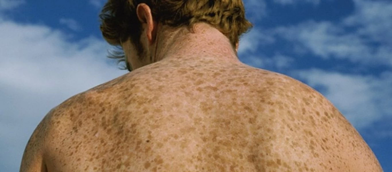 Πώς μπορείς να αντιμετωπίσεις τις κηλίδες στο πρόσωπο σου;